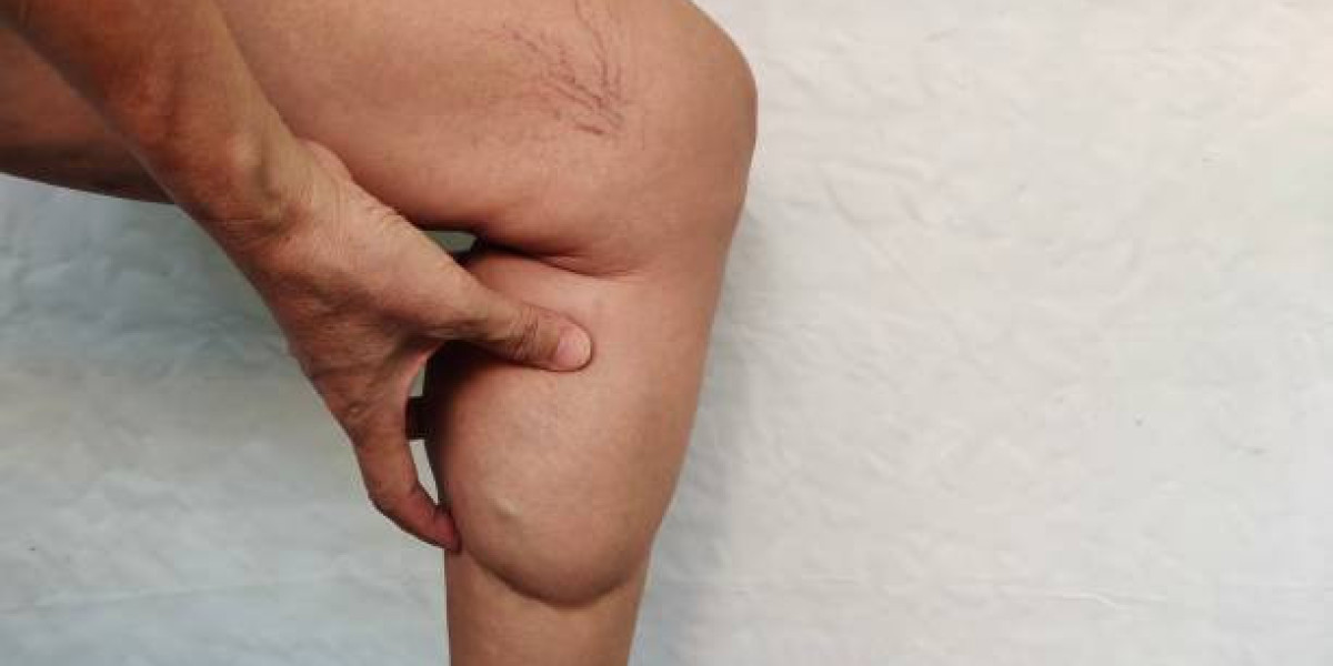 Lipedema Treatment Options That Help Manage Chronic Fat