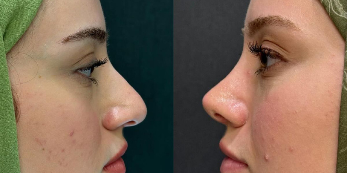 Achieve a Harmonious Look with Rhinoplasty in Islamabad
