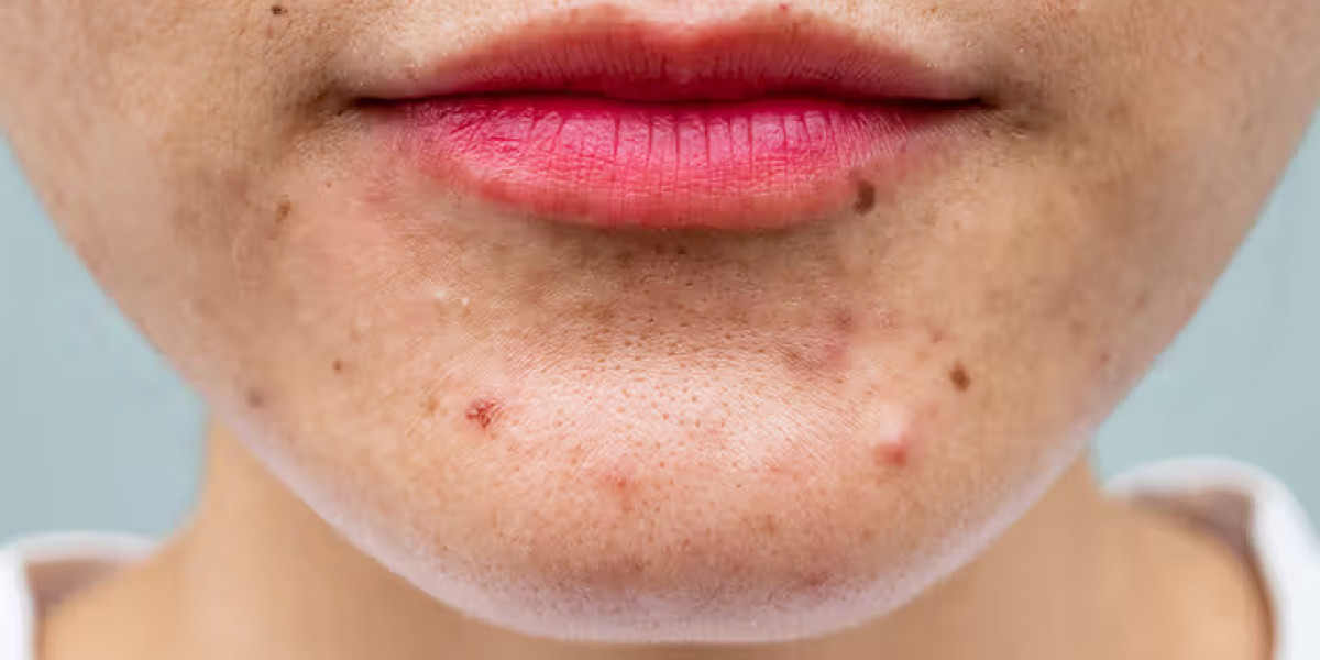 Acne: Treatment, Types, Causes, Prevention, and More