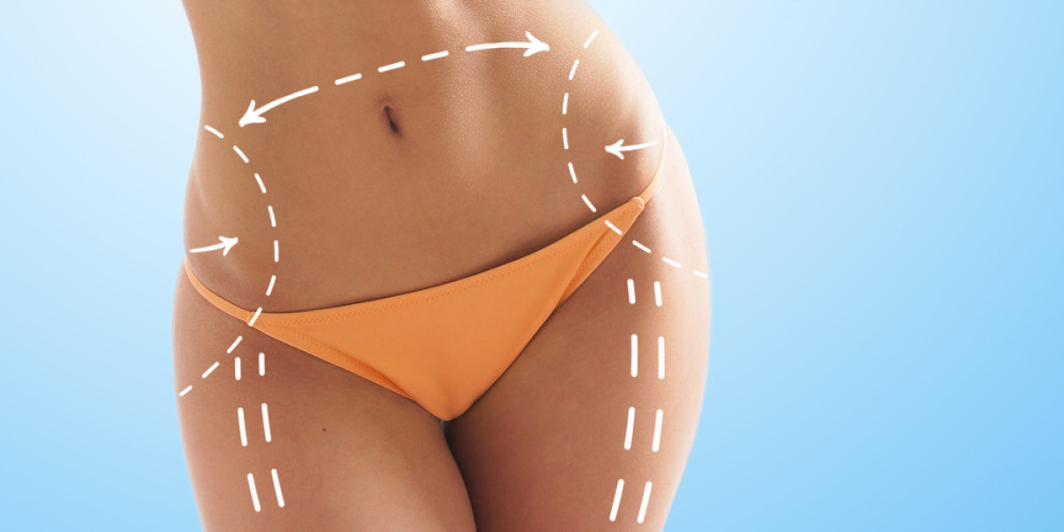 Managing Bruising After Liposuction Procedure