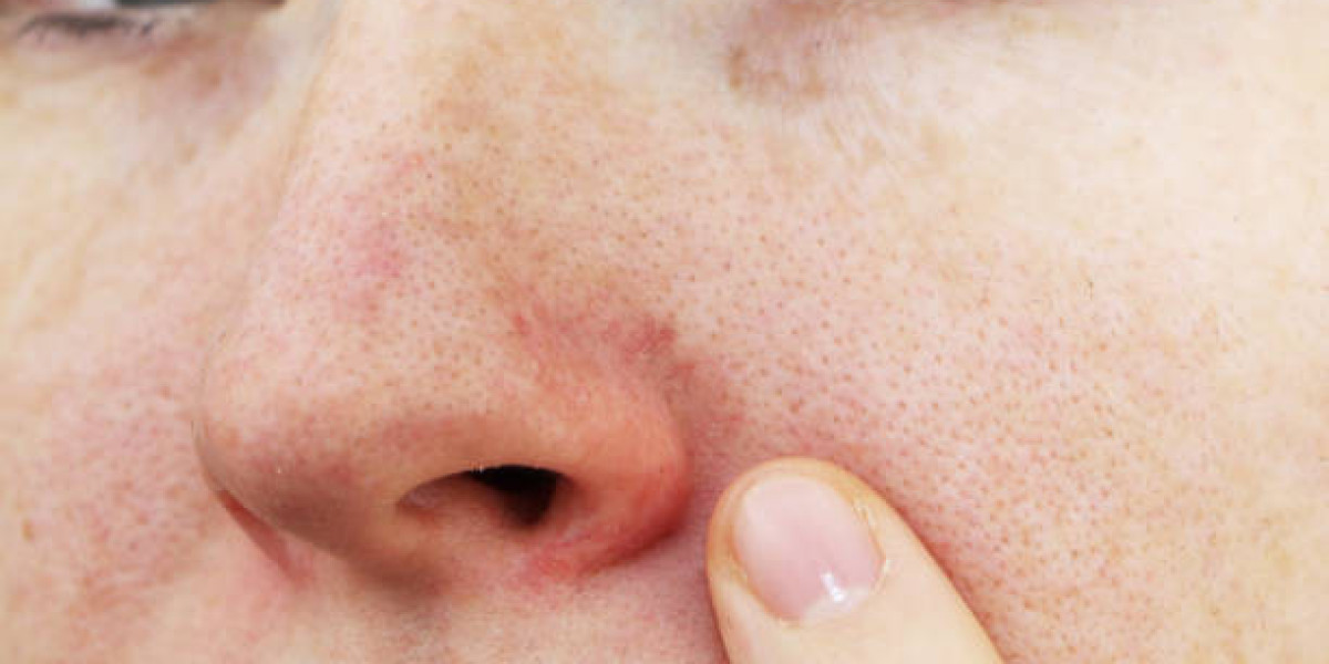 Nose Red from Wiping: Gentle Habits