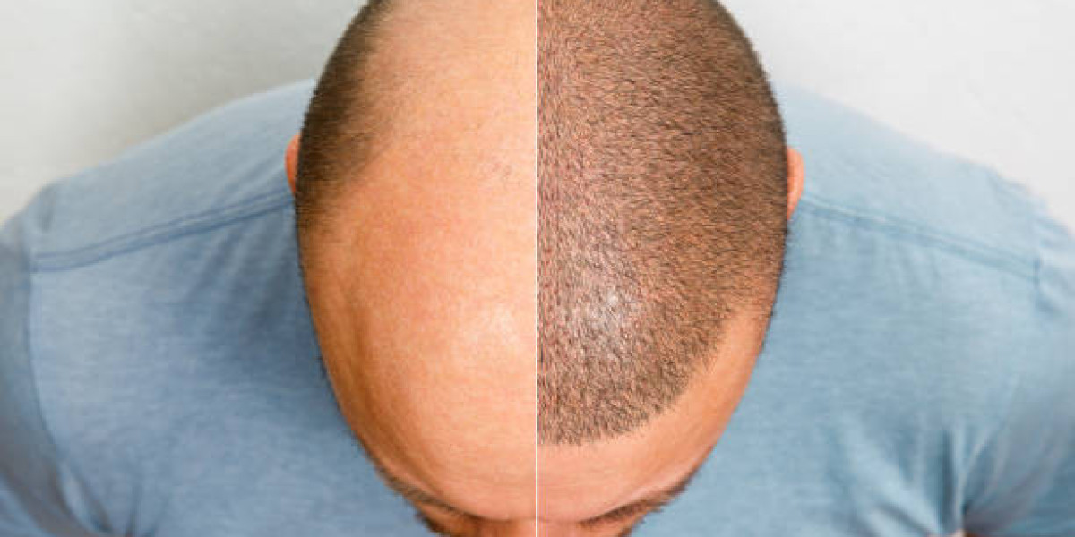 Enhance Looks with Riyadh Hair Transplant