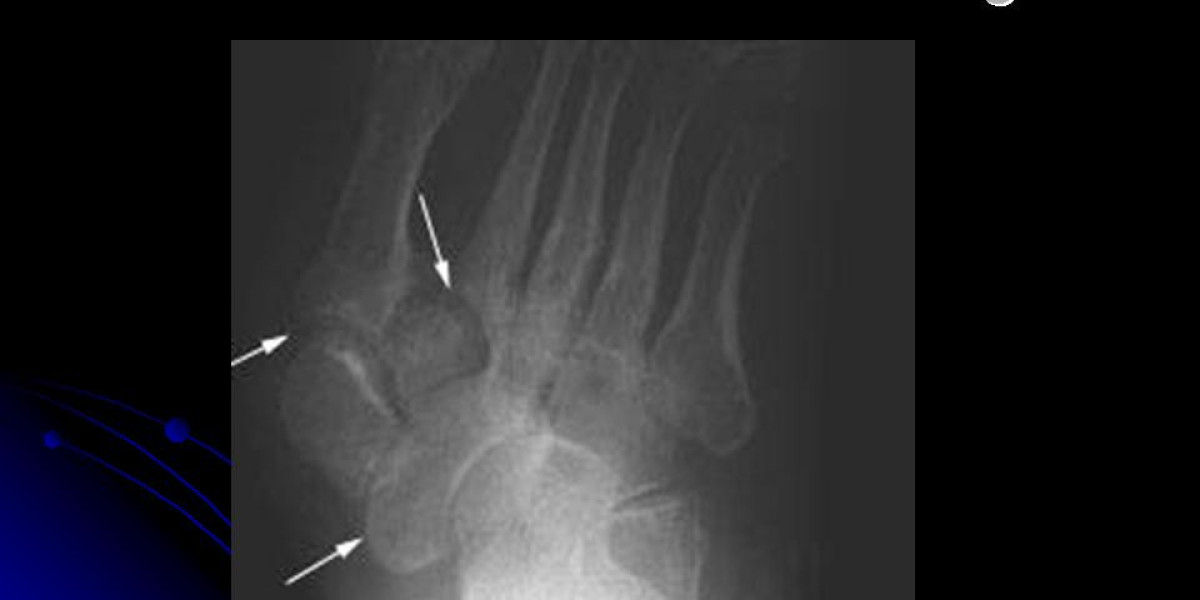 Fractures & Dislocations: Signs, Risks, and Healing