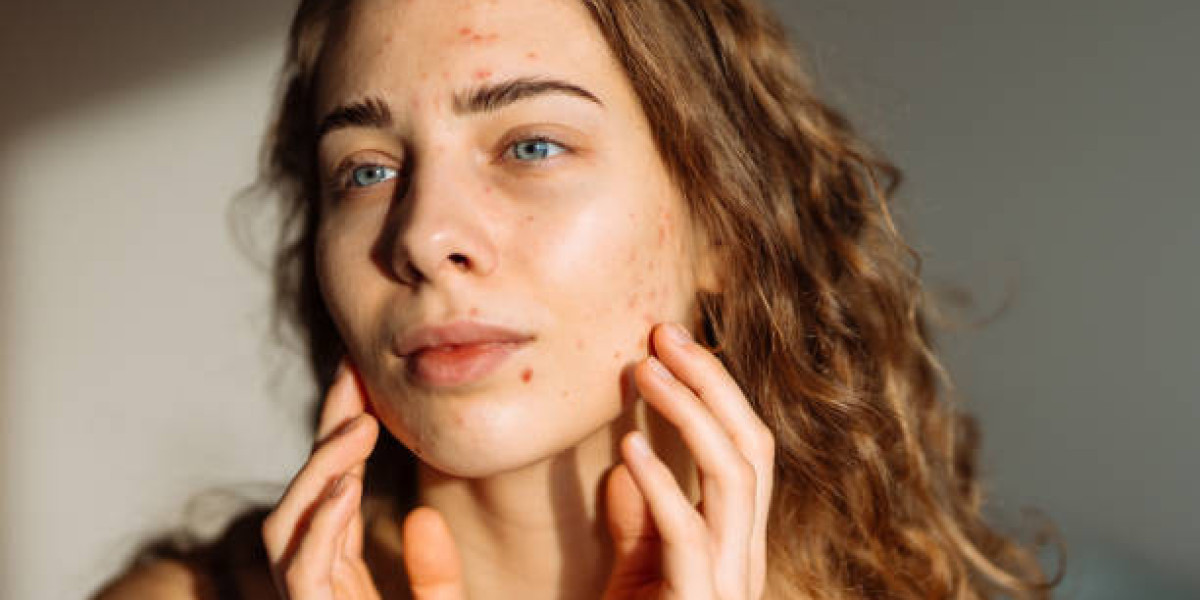 Laser Acne Treatment Aftercare for Best Results