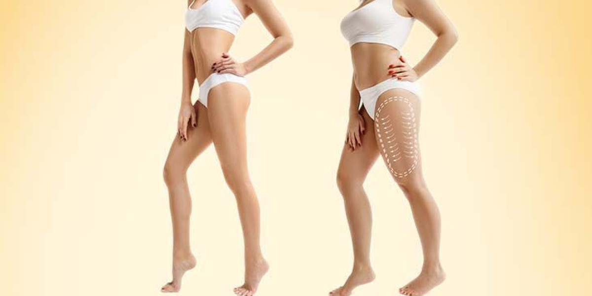 Liposuction In Dubai with Precision | Dr Anshu Mishra – Best Plastic Surgeon in Dubai