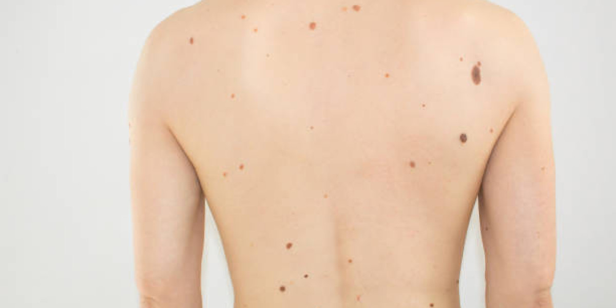 Natural vs Dramatic Skin Tag Removal: Finding Your Perfect Balance