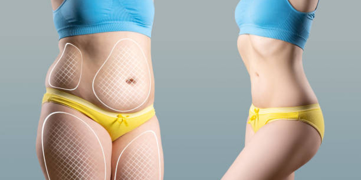 Who Qualifies as Ideal Candidate for Liposuction