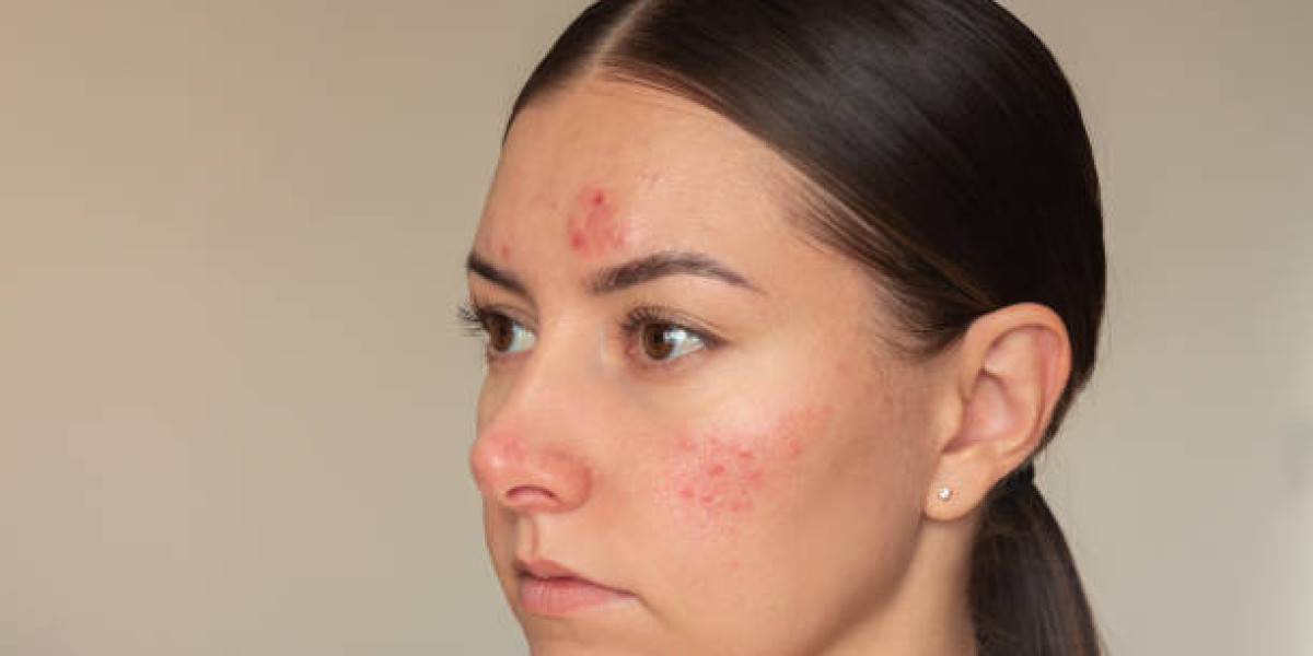 Perinasal Redness: What Causes It and How to Treat Fast