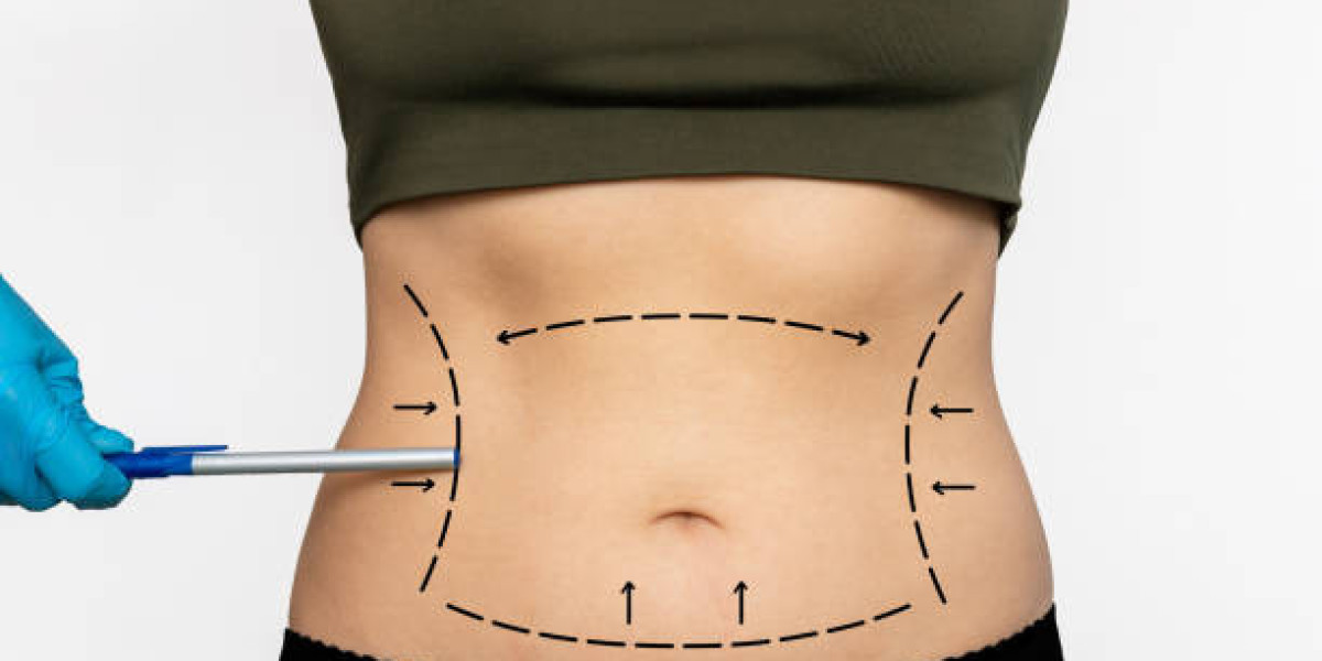 Liposuction Side Effects and How to Minimize Them
