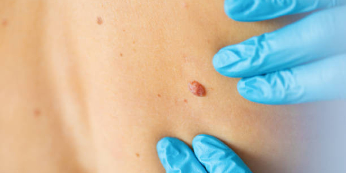 Skin Tag Removal Facts Everyone Should Know About Skin