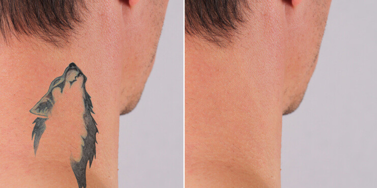 How to Choose the Right Specialist for Laser Tattoo Removal in Islamabad