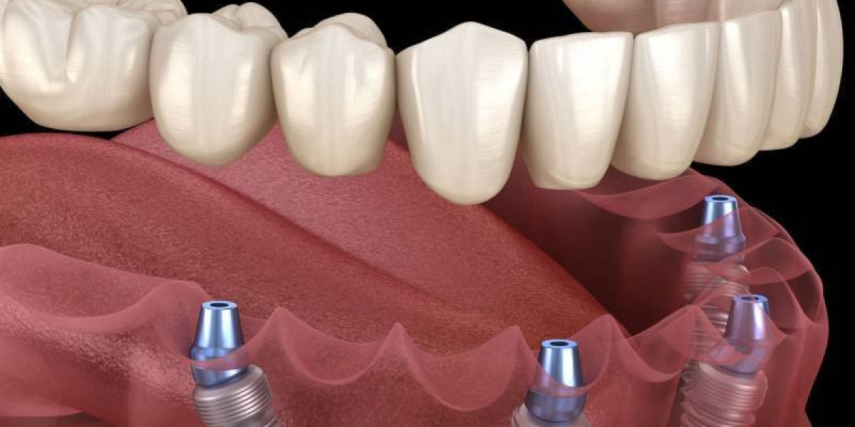 How Can Dental Implants Offer Long-Lasting Smiles With True Comfort