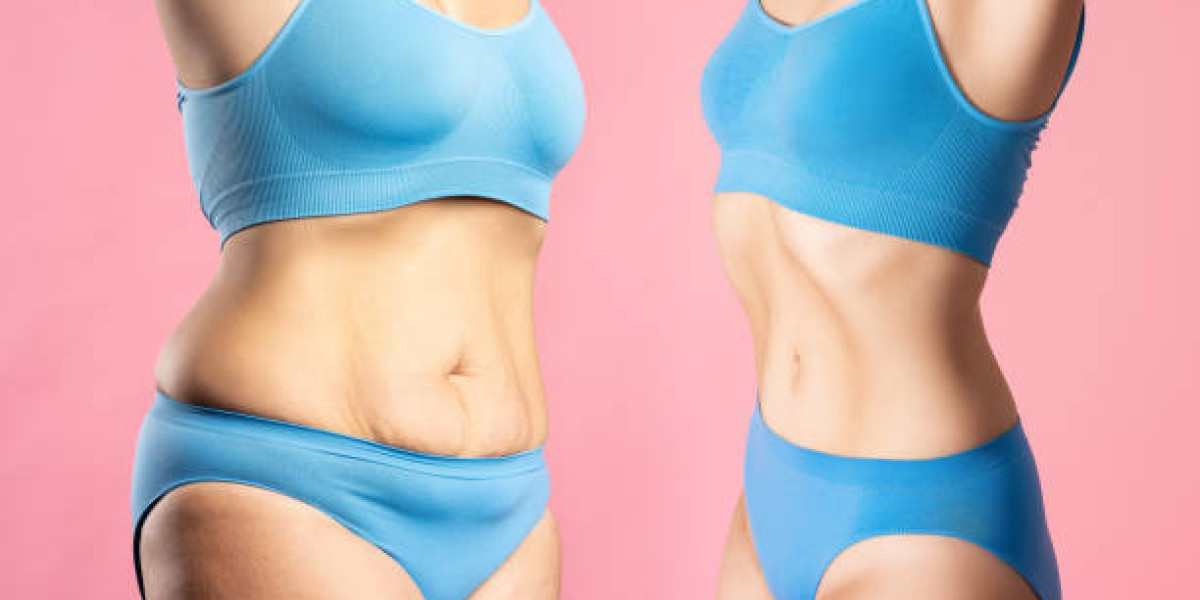 Liposuction in Riyadh Myths Busted: Get the Real Facts Here