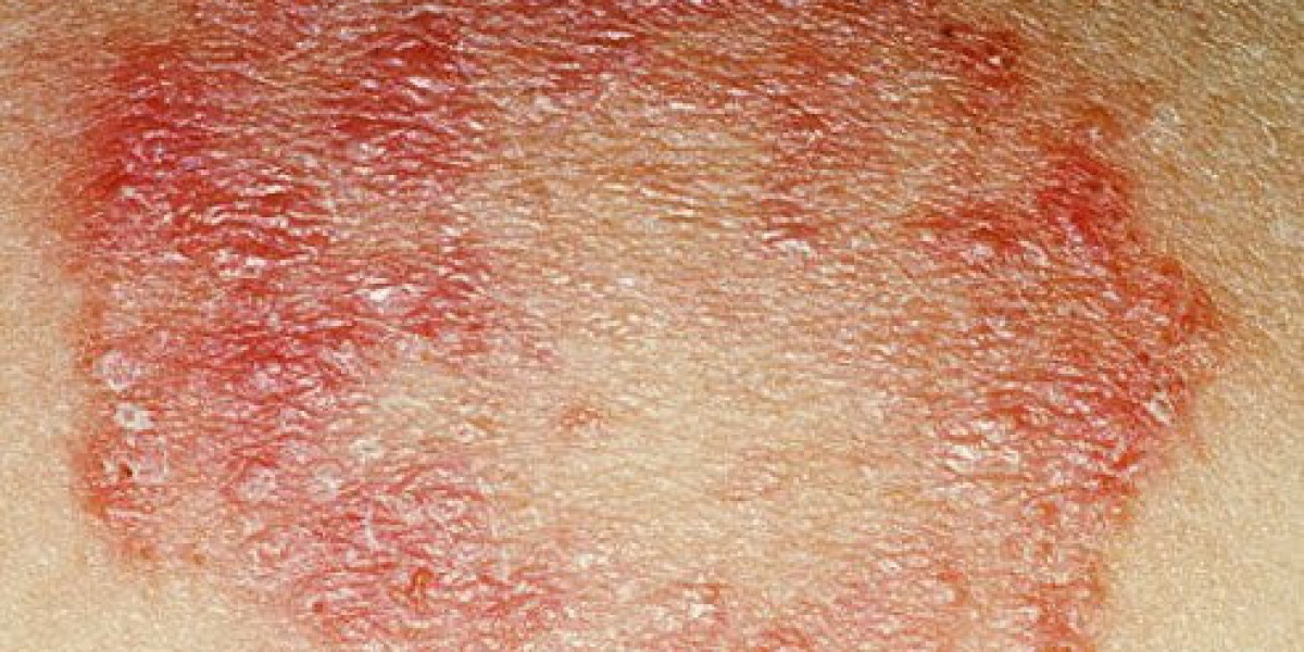 Quick Fixes for Bacterial Skin Infections