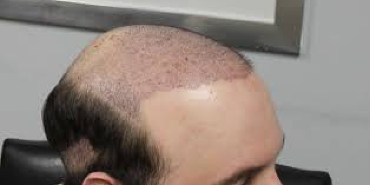 FUE Hair Transplant Myths Busted for Riyadh Seekers