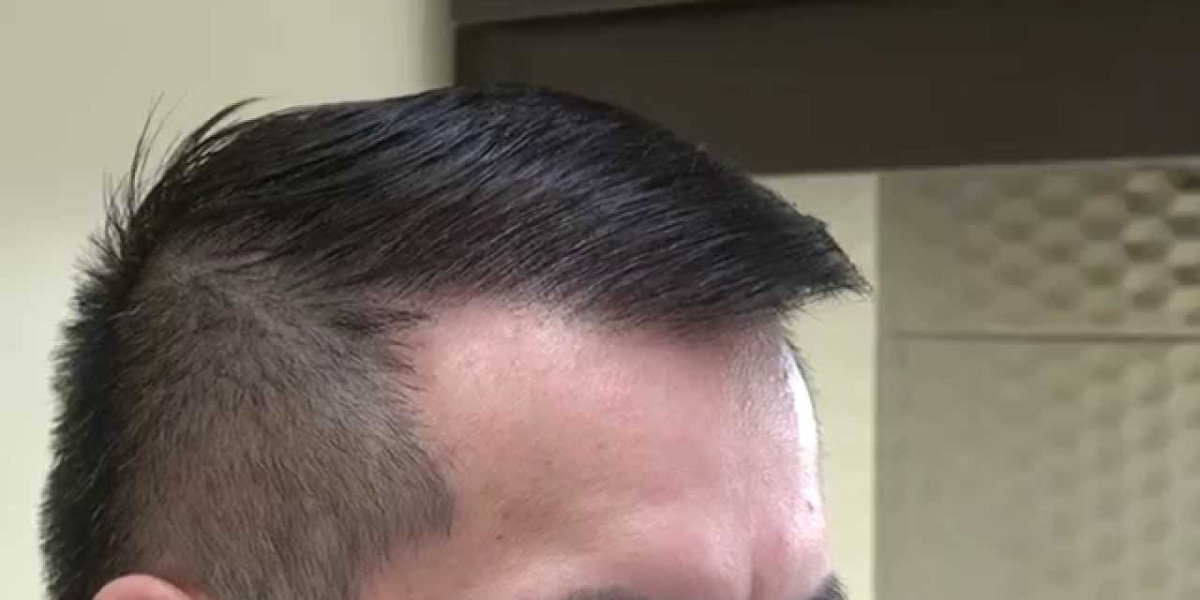 How Does Hair Transplant in Dubai Restore Confidence?