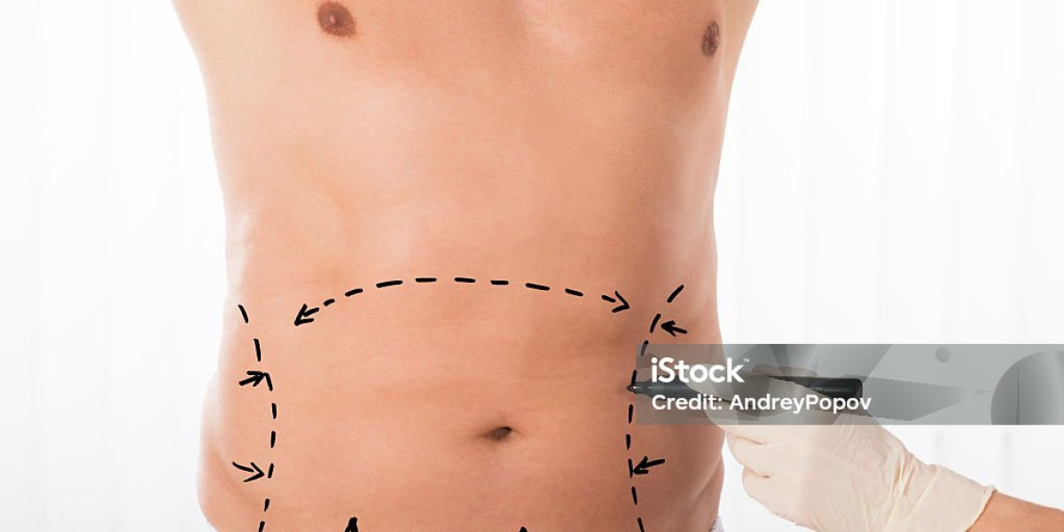 Benefits of Choosing Liposuction in Dubai