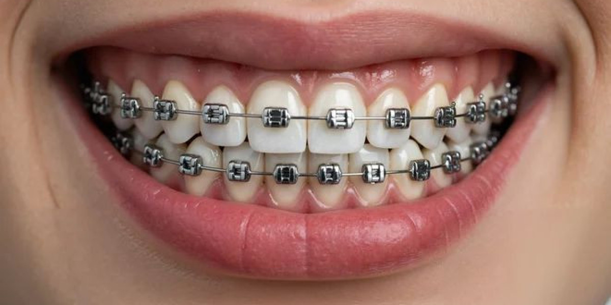 Enhance Your Smile Journey with Dental Braces in Islamabad