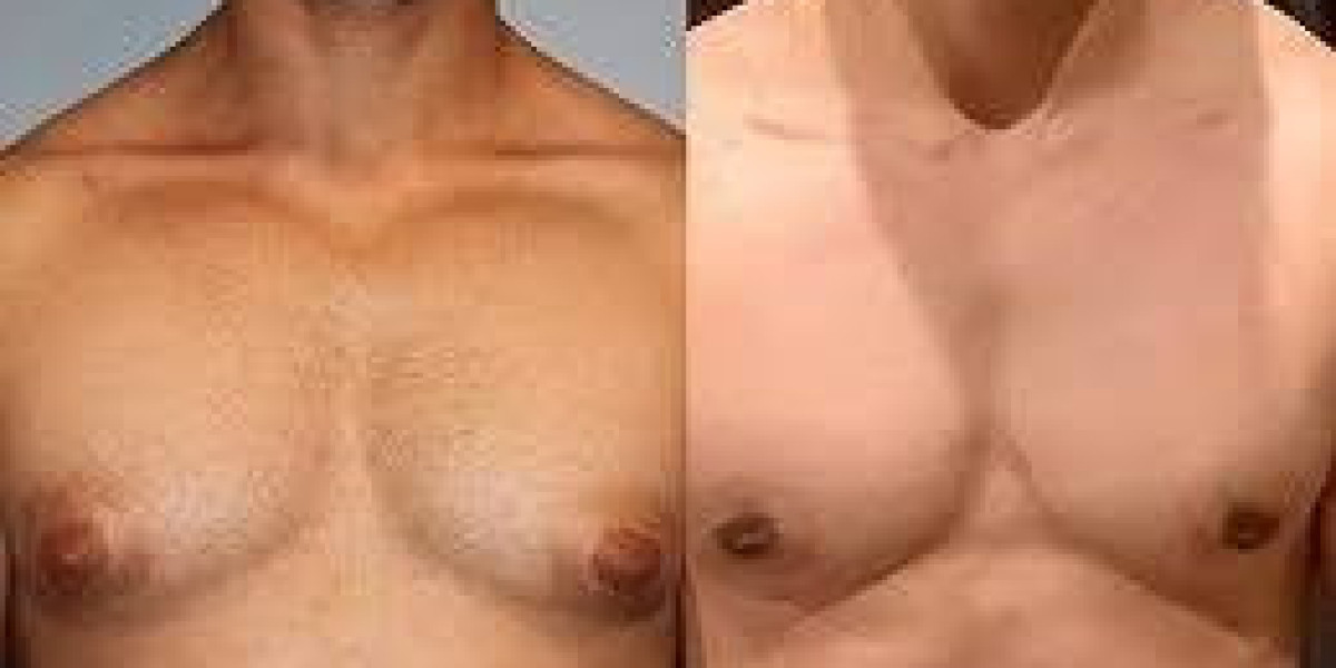 Achieving a More Masculine Chest: Your Guide to Male Breast Reduction in Dubai