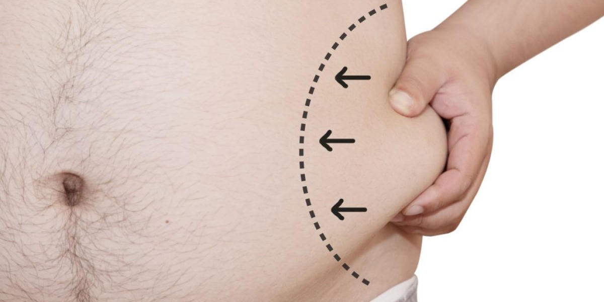 Can Liposuction Give You the Confidence of a Sleek, Perfect Body Fast