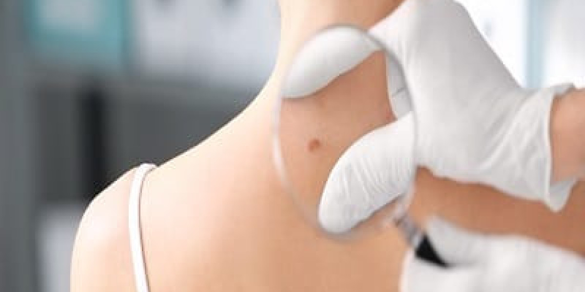 Non-Invasive Birthmark Removal Techniques in Dubai