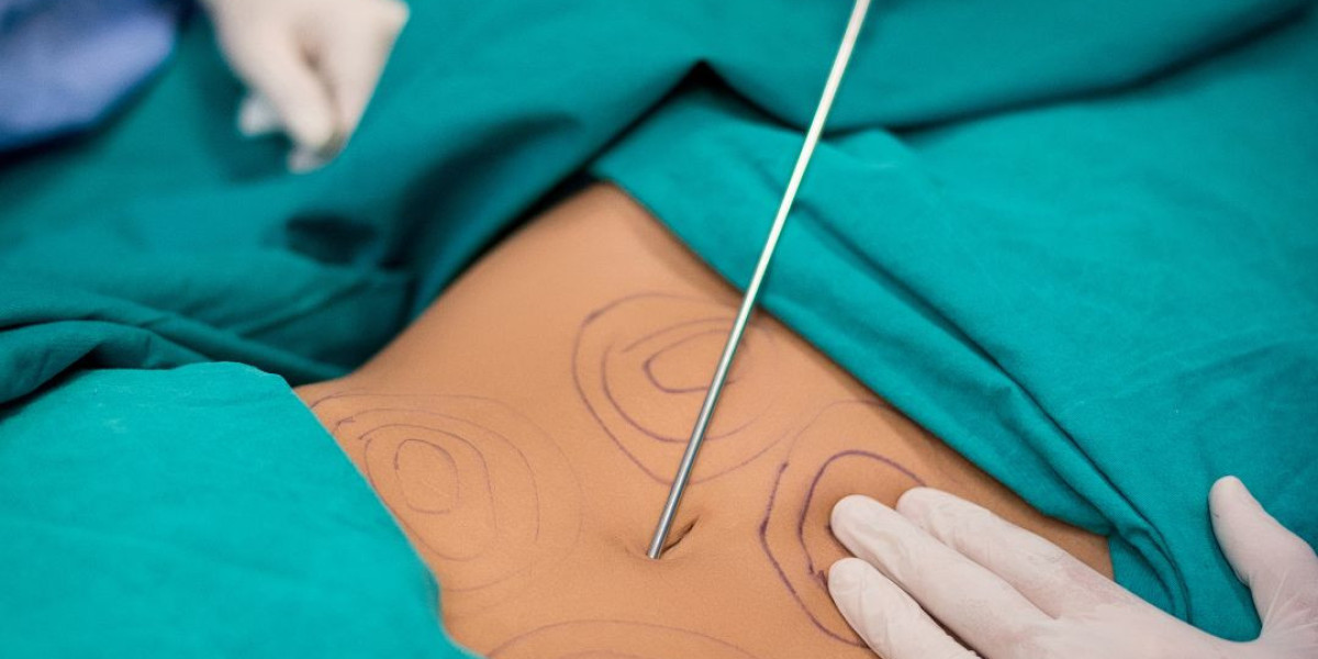 Liposuction in Islamabad – Achieve Your Ideal Body Shape