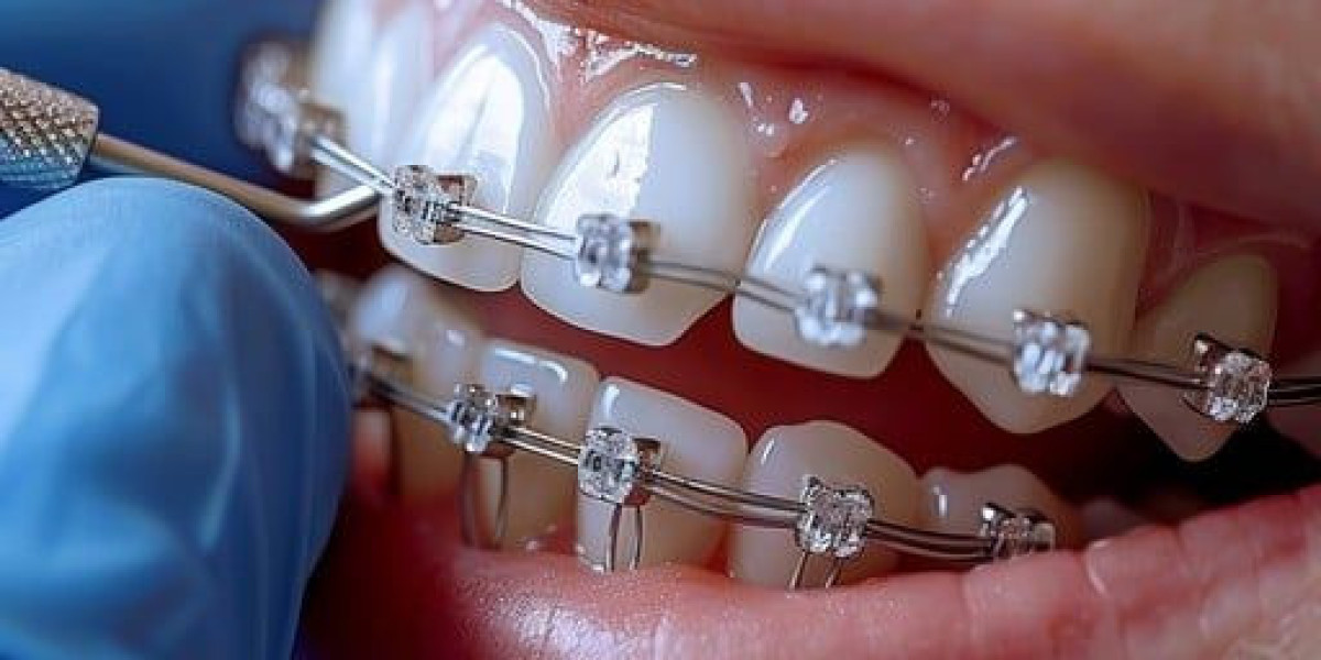 Straighten Your Teeth with Dental Braces in Islamabad