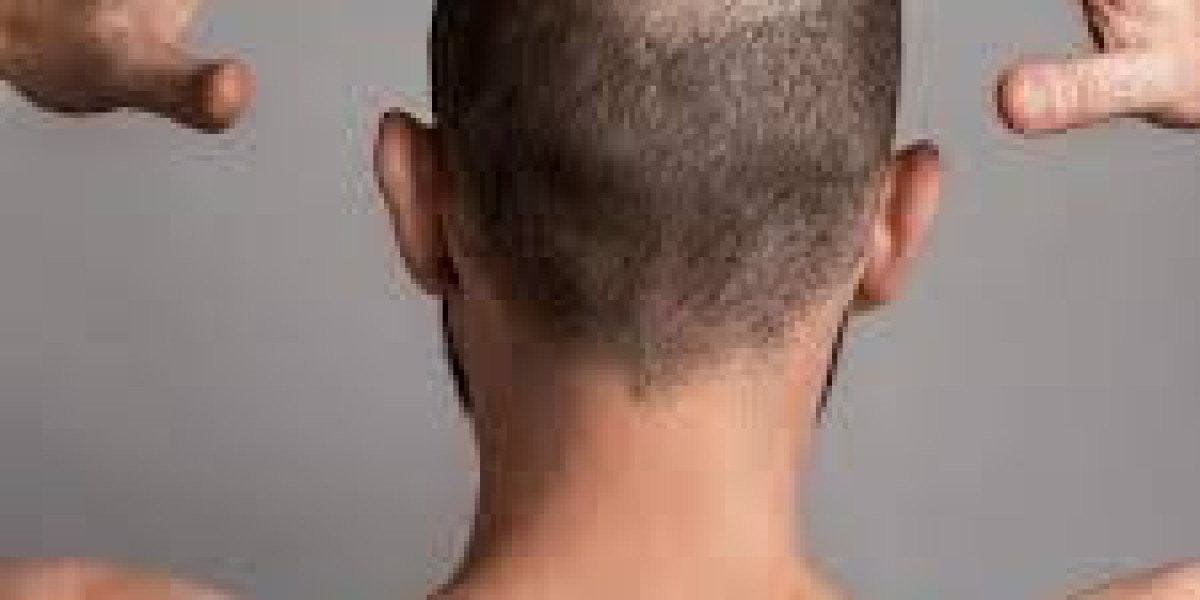 Reversing Hair Loss: Your Comprehensive Guide to Hair Transplantation in Dubai