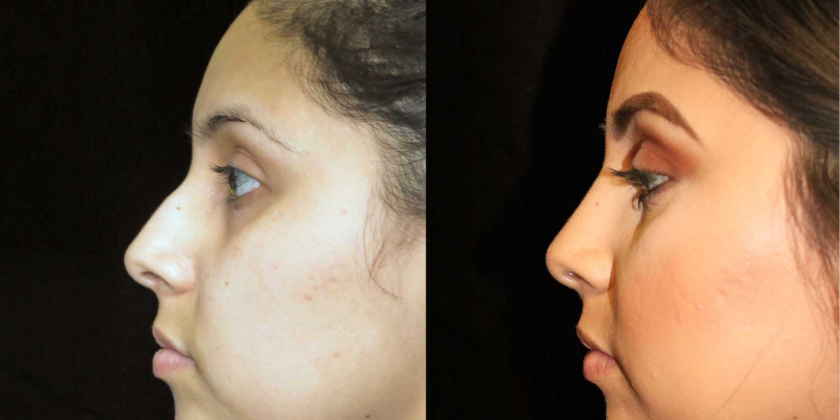 لماذا تعتبر دبي الوجهة الأولى عالمياً لعمليات تجميل الأنف؟