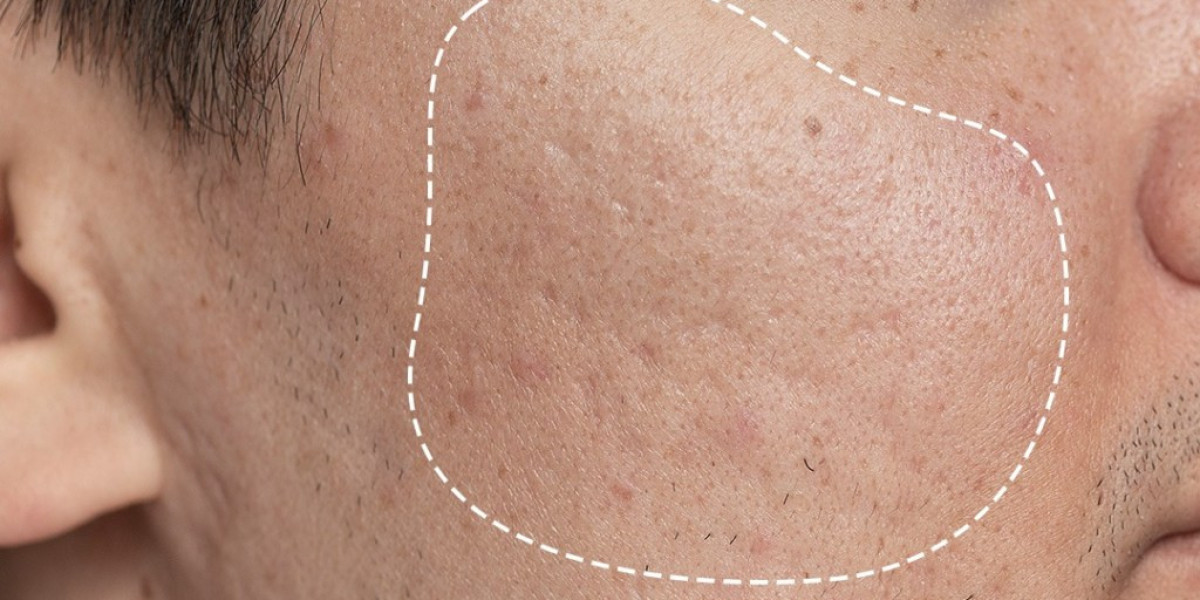 Large Pores Treatment Cost: What Influences the Cost the Most?