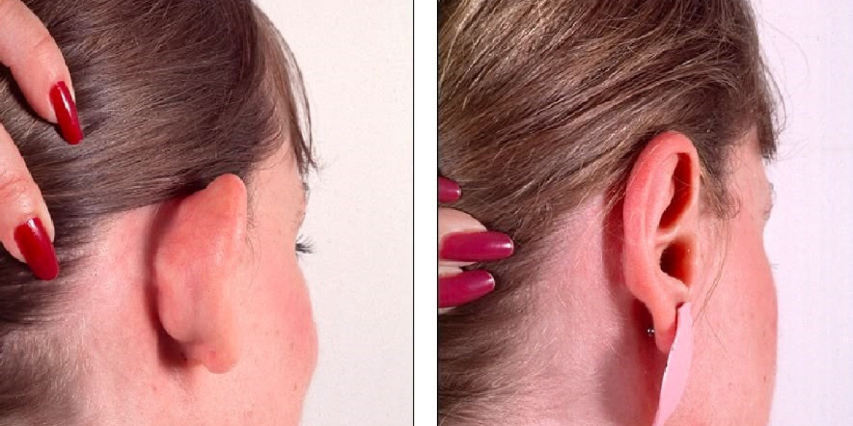 Ear reshaping in Dubai: Enhancing Harmony for a Refined Look