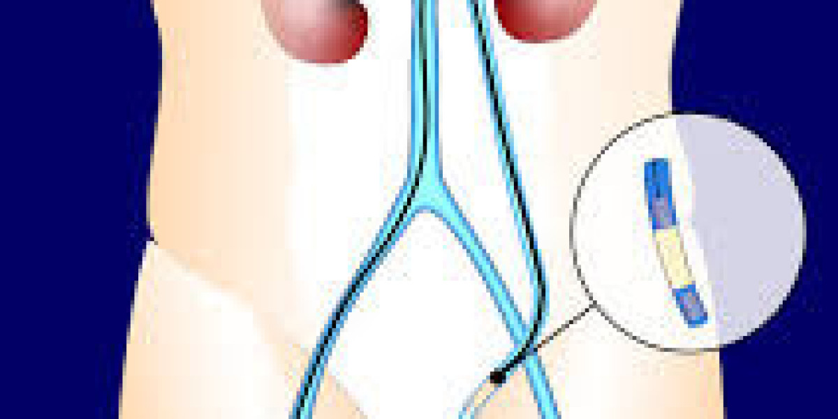 Varicocele Embolization: A Modern Treatment for Male Fertility