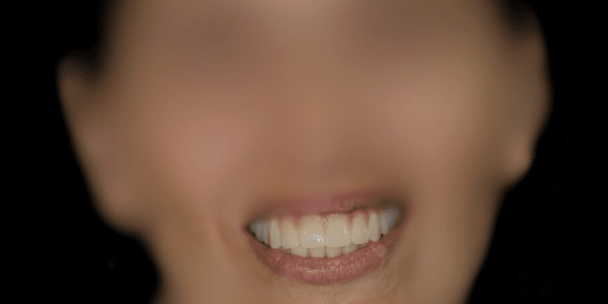 Implante Dental en Hospitalet de Llobregat Recupera tu Sonrisa