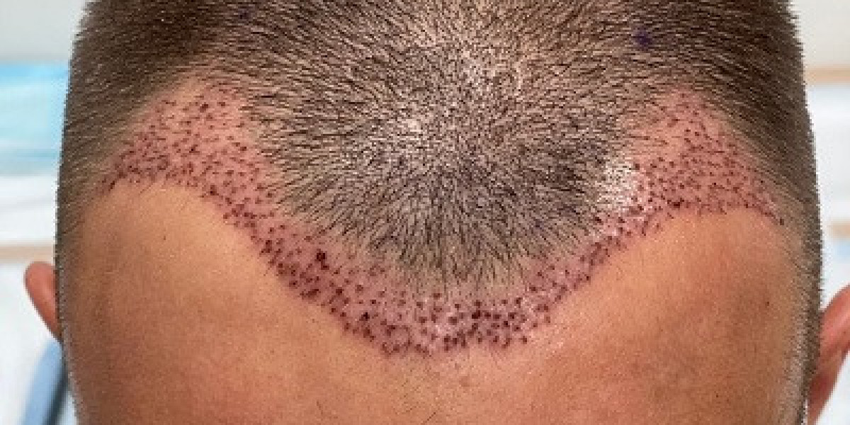 Hair Regrowth Treatment Centers in Dubai: Restore Your Confidence