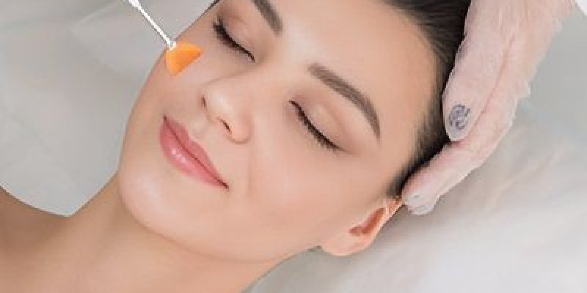 Chemical peels in Dubai: What to Expect During Recovery