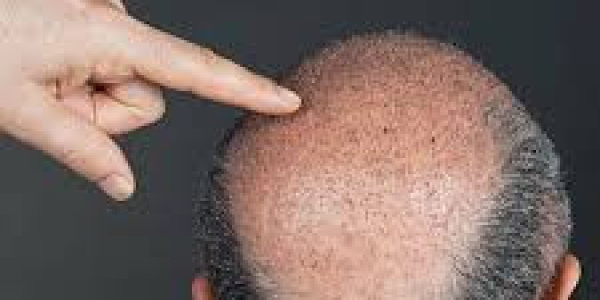 Top-Rated Hair Restoration Specialists in Dubai