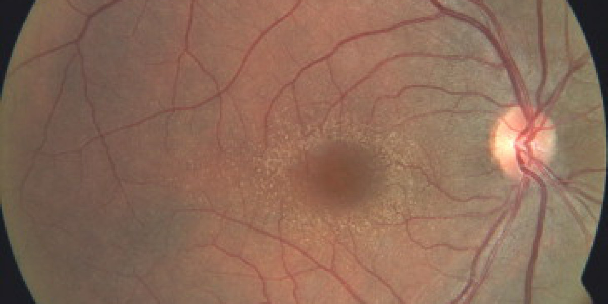 Alport Syndrome Market Size, Trends, and Growth Forecast 2026-2033