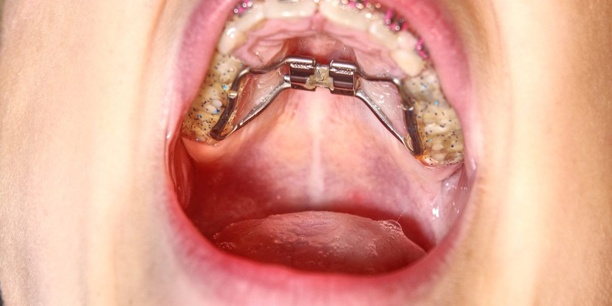 Can Dental Braces Fix Jaw Misalignment?