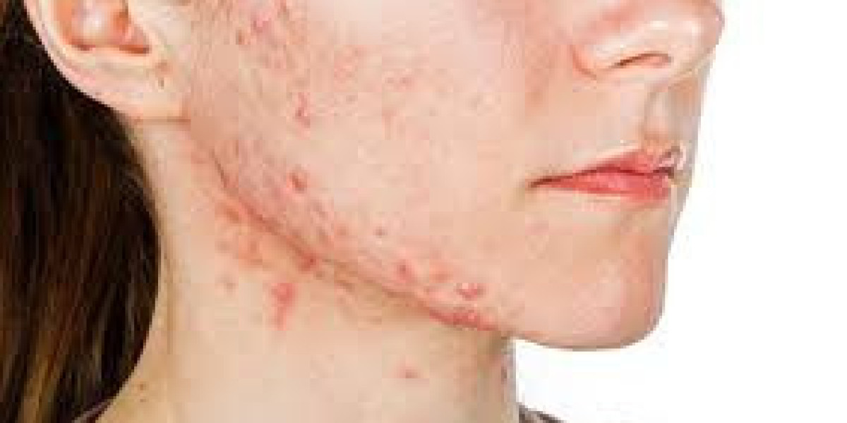 Non-Invasive Pimples Therapy in Dubai: Achieving Flawless Skin Without Surgery