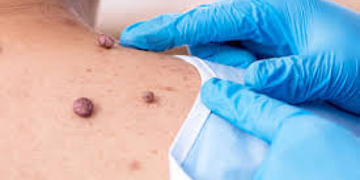 A Comprehensive Guide to Choosing the Right Professional for Mole Removal in Dubai