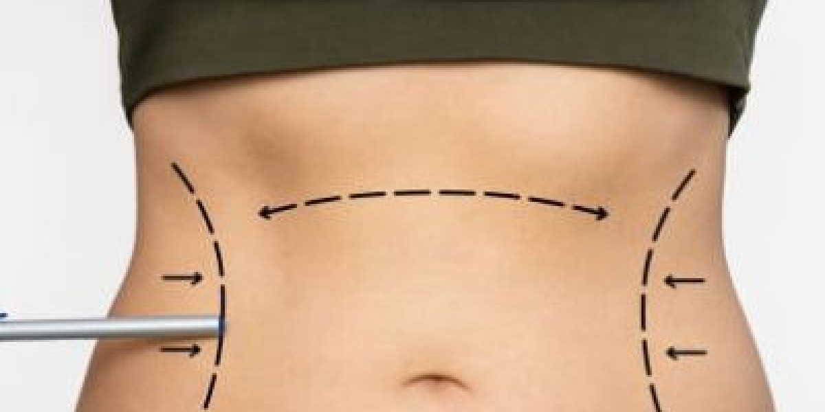 Refining Your Silhouette: A Guide to Liposuction After Significant Weight Loss in Dubai