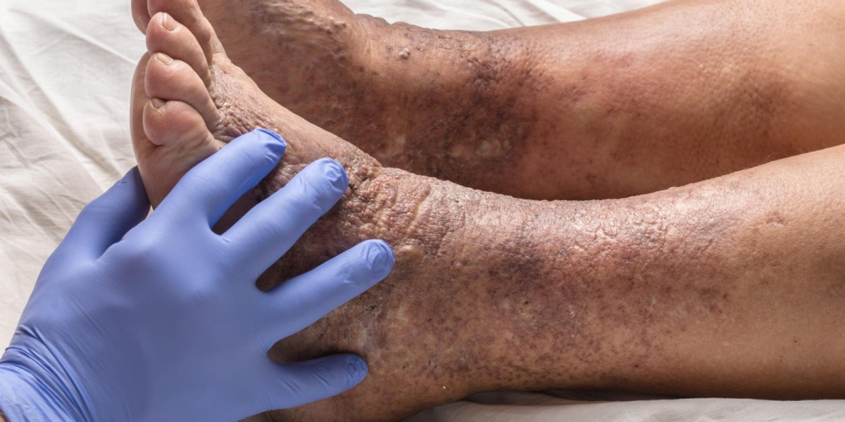 Diabetic Foot Care at Home in Dubai Expert Care Guide
