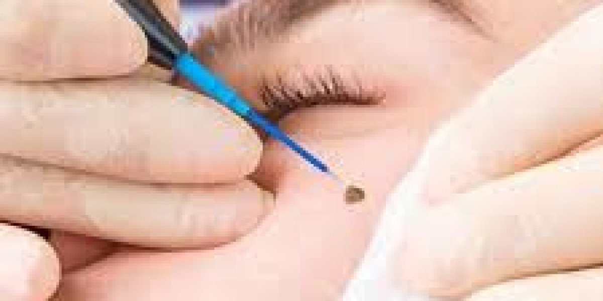Skin-Friendly Laser Wart Removal in Dubai – Safe and Effective Skin Treatment