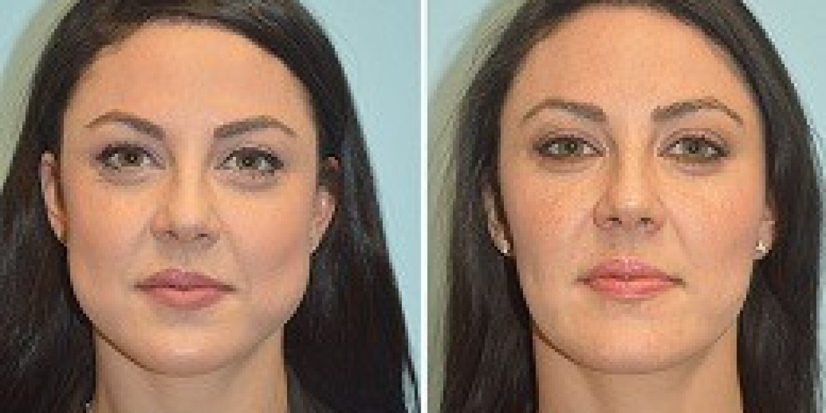 Buccal Fat Removal Testimonials Dubai – Real Experiences and Facial Slimming Insights