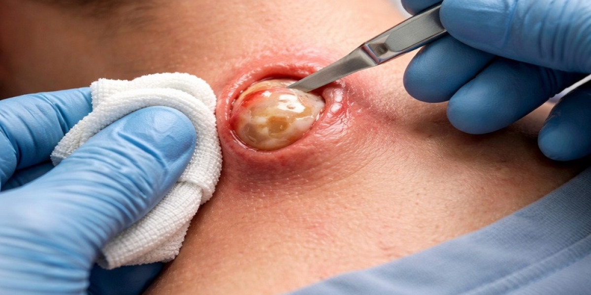 Expert Tips for Safe Mole Removal in Islamabad – Here’s Why