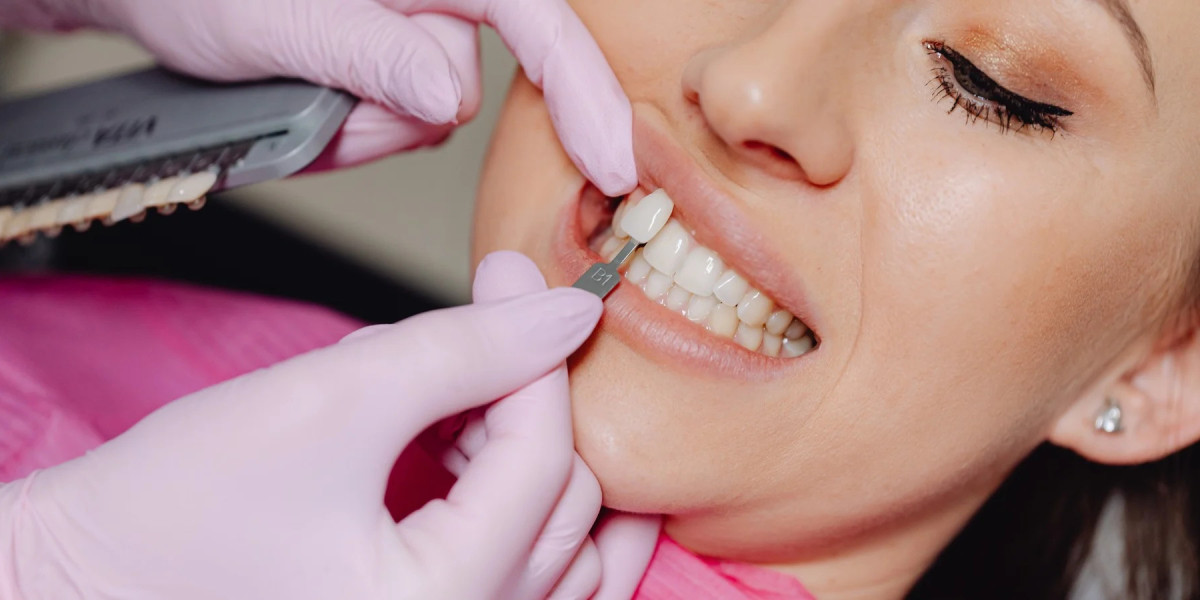 E-Max Veneers Enhance Facial Harmony with Stunning Smile Flow