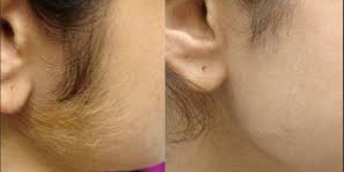 Certified Laser Hair Bleaching Clinics Near Me in Dubai | Safe Hair Lightening Guide