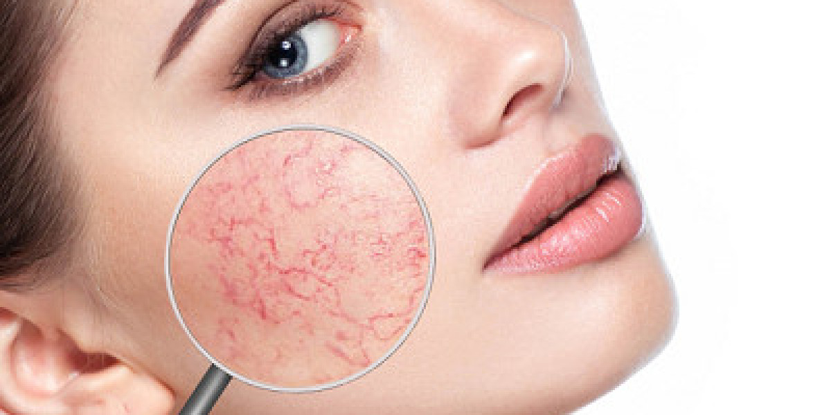 Islamabad’s Leading Clinics for Rosacea Treatment
