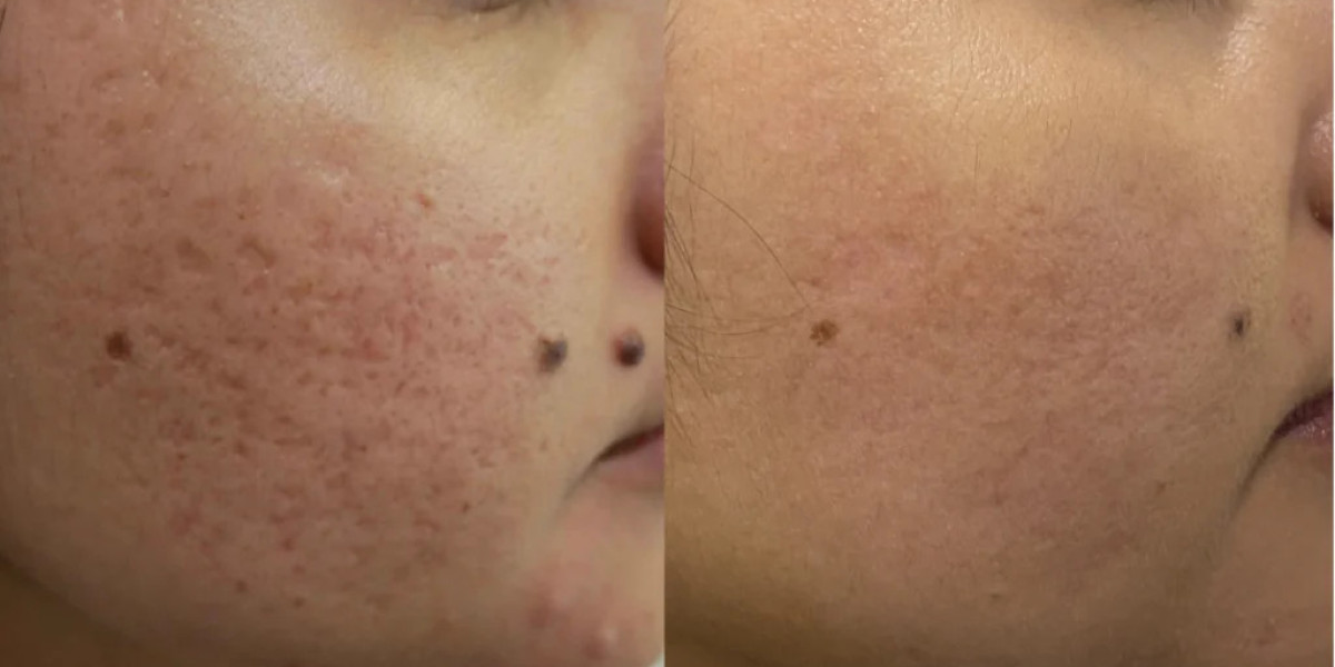 Fractional CO2 Laser Treatment for Skin Tightening: Complete Guide