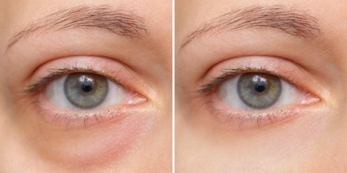 Eye Bag Removal for Dark Circles vs Puffiness